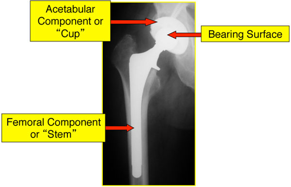Anatomy of a Total Hip Replacement