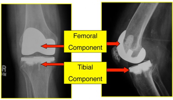 Total Knee Replacement Anatomy