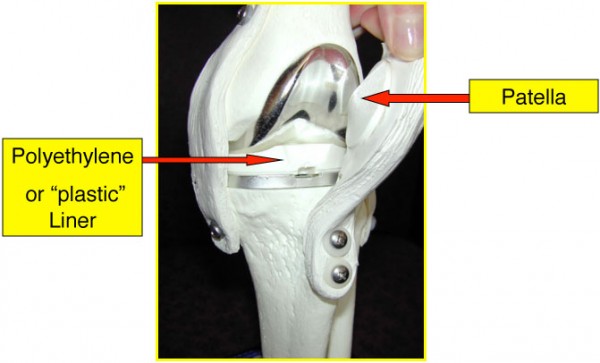 Total Knee Replacement Anatomy 2