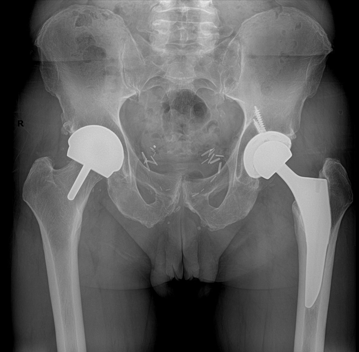 Dr. Craig J. Della Valle, Hip and Knee surgeon Hip Resurfacing - Dr